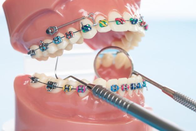 orthodontic-model