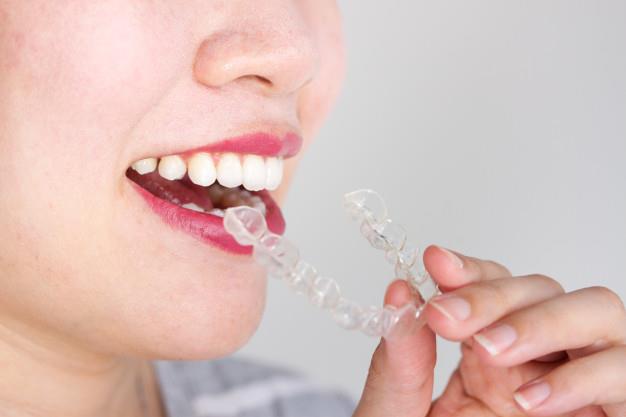 invisalign-braces