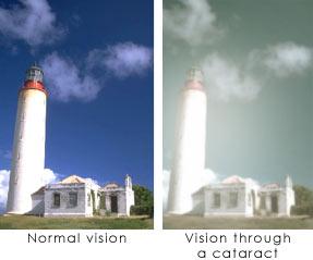 cataract vision
