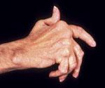 Arthritis