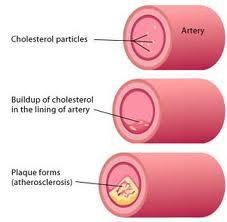 Cholesterol 